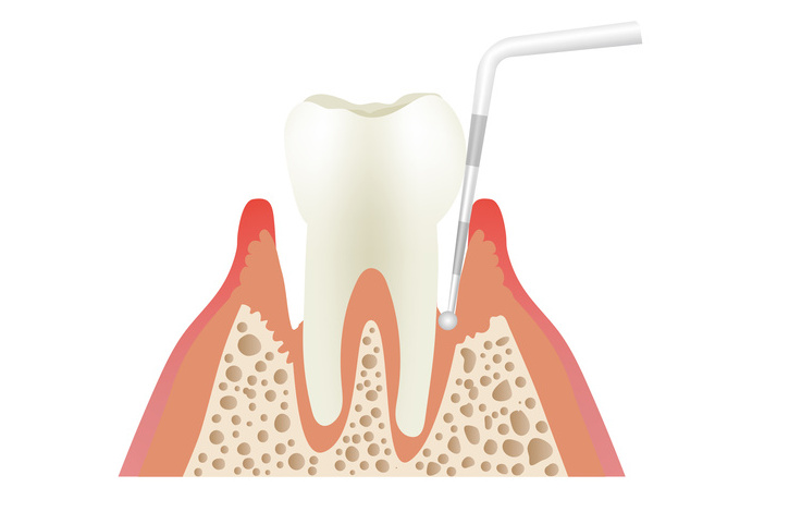 歯周外科治療（フラップ手術）とは